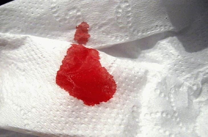 Lòi dom có thể gây chảy máu với lượng nhỏ trong giai đoạn đầu
