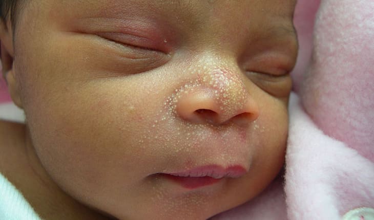 Mụn sữa thường xuất hiện ngay sau khi trẻ mới sinh