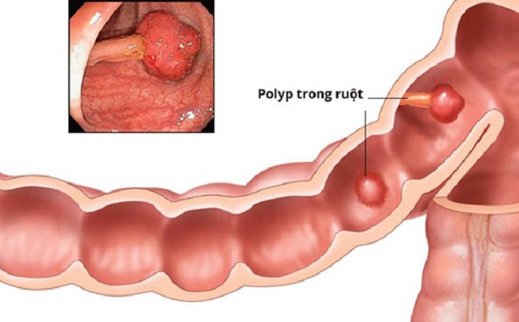 Polyp đại tràng sigma là hiện tượng niêm mạc đại tràng có khối u