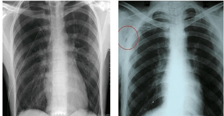 X quang phổi - Cách chẩn đoán tình trạng lây lan của ung thư amidan