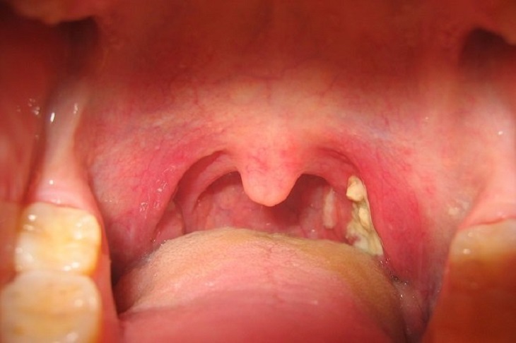 Hình ảnh amidan lưỡi gây nhiều biến chứng nguy hiểm
