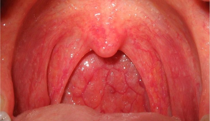 Bệnh viêm họng dị ứng