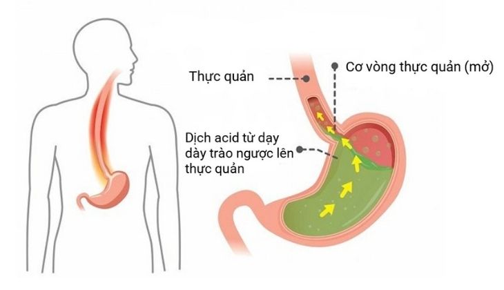 Nguyên nhân gây ra viêm họng trào ngược