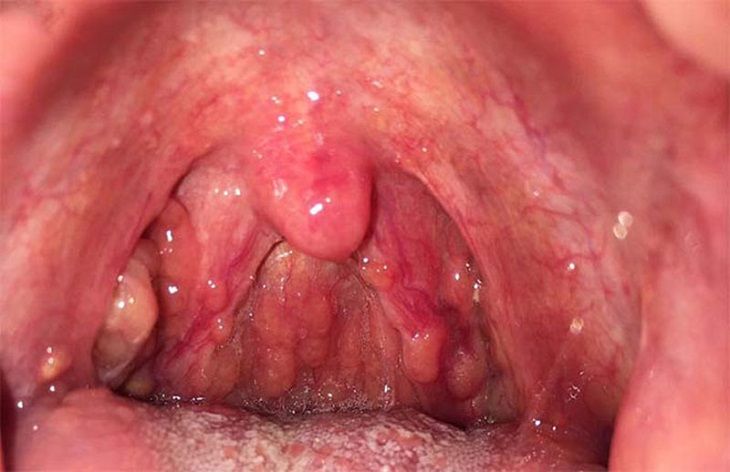 Viêm họng hạt mãn tính xảy ra khi viêm họng thường xuyên tái phát