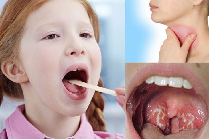 Viêm họng là tình trạng thường gặp ở trẻ