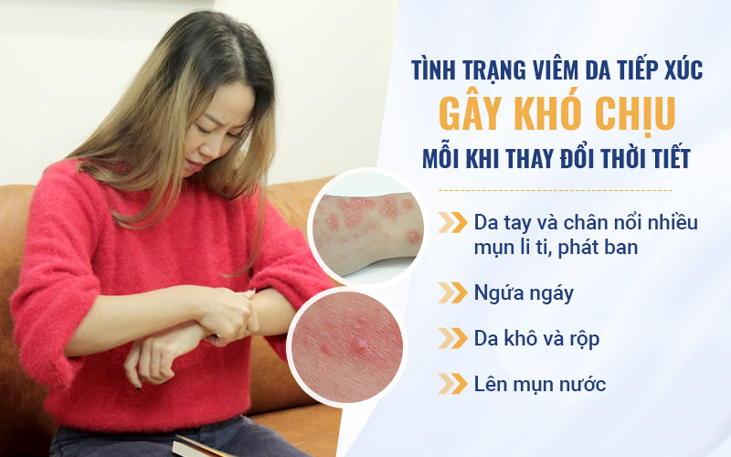 Nữ diễn viên Vân Anh đã mắc viêm da tiếp xúc hơn 20 năm