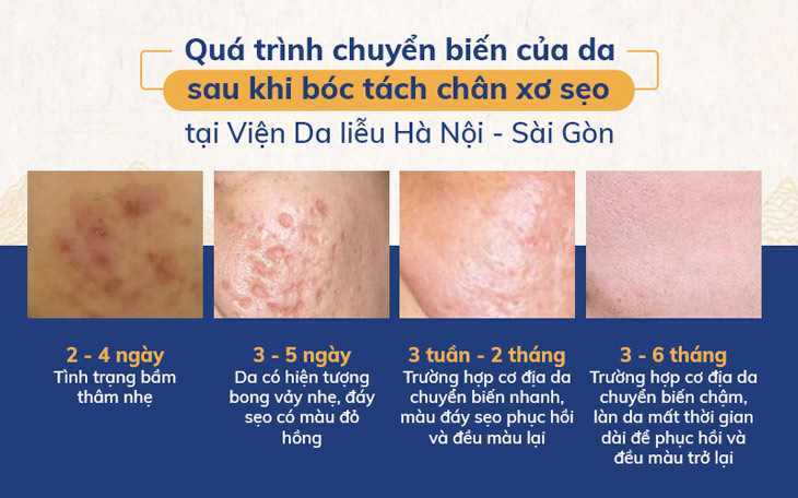 Quá trình chuyển biến của da sau khi bóc tách đáy sẹo tại Viện Da liễu Hà Nội - Sài Gòn