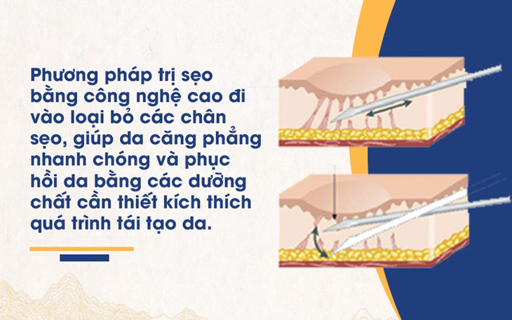 Nguyên lý hoạt động của công nghệ bóc tách đáy sẹo tại Viện Da liễu Hà Nội - Sài Gòn