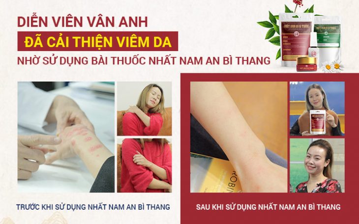 Diễn viên Vân Anh cũng điều trị viêm da dai dẳng với bài thuốc Nhất Nam An Bì Thang và đã được cải thiện tình trạng này rất tốt