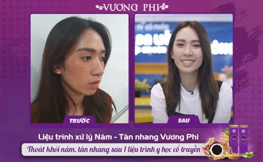 Điều gì làm nên khả năng xử lý nám - tàn nhang tuyệt vời của Vương Phi, giúp cô gái trẻ tự tin khoe mặt mộc chỉ sau 2 tháng trải nghiệm