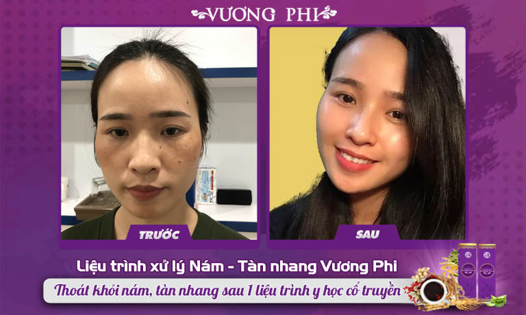 Tình trạng da của khách hàng điều trị nám tàn nhang tại Trung tâm Da liễu Đông y Việt Nam