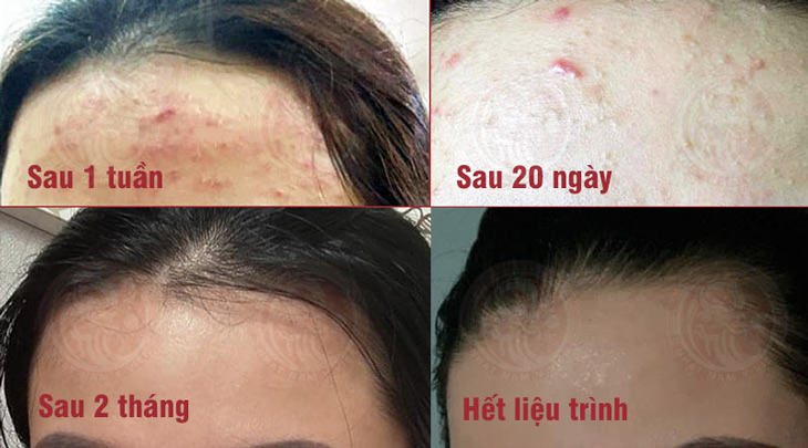 Làn da sạch mụn của chị Khánh Vân sau khi sử dụng Nhất Nam Hoàn Nguyên Bì 